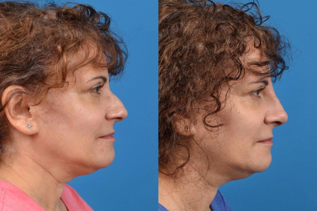 Liquid Rhinoplasty Photos Melbourne, FL Patient 8045